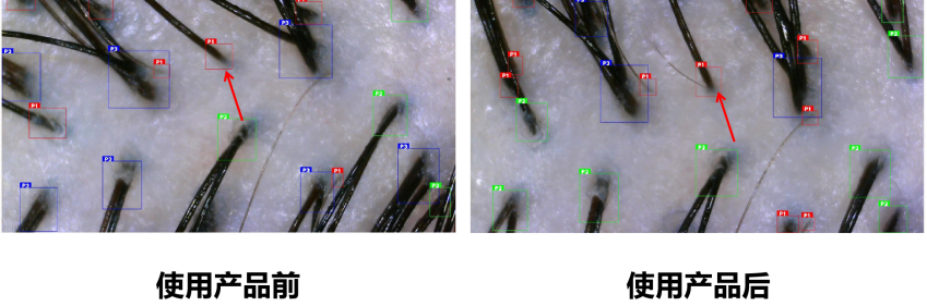 頭皮健康,紅斑,,丘疹,膿皰,評價(jià)方法